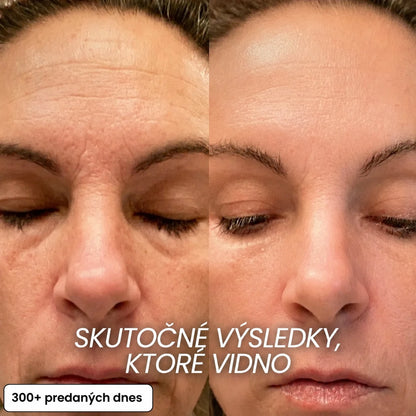 Vypĺňací stick Bio-Kolagén PDRN